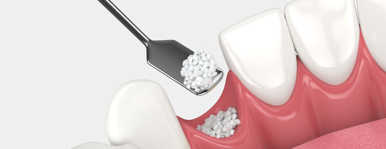 Bone Grafting in Pasadena, TX